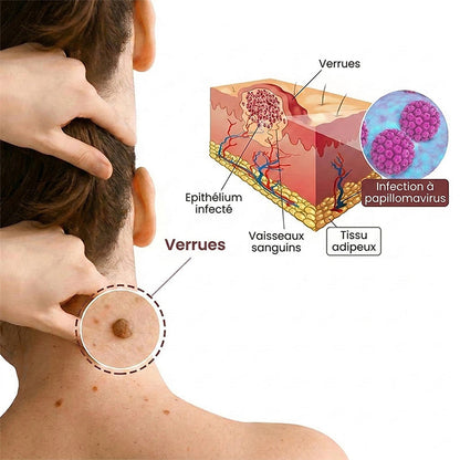 AuraGen® Stylo à double embout pour l'élimination des verrues