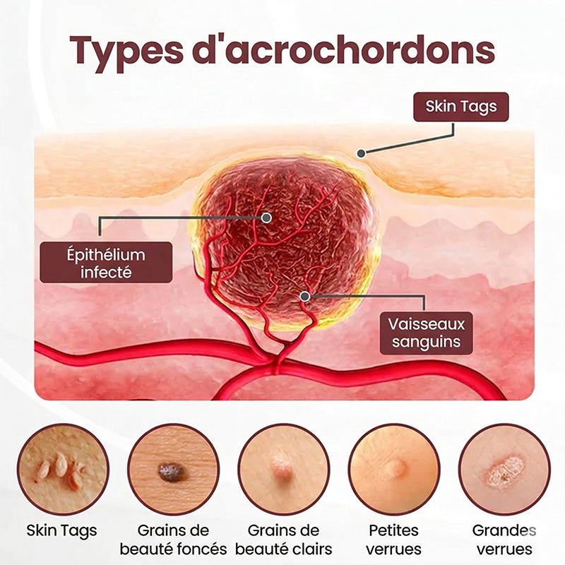 AuraGen® Stylo à double embout pour l'élimination des verrues