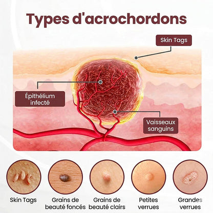 AuraGen® Stylo à double embout pour l'élimination des verrues